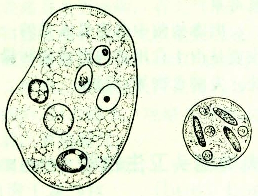 溶组织内阿米巴病